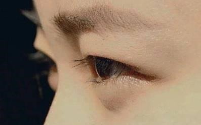 科普 别再贴双眼皮贴啦,眼皮下垂不可逆|医美科普!