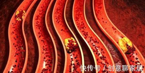 高血压|为何推荐高血压患者联合用药?弄清以下6点,学会联用降压药