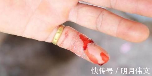 发红|身体2个地方发红、2个地方出血,糟糕:肝硬化“上身”了,勿忽视