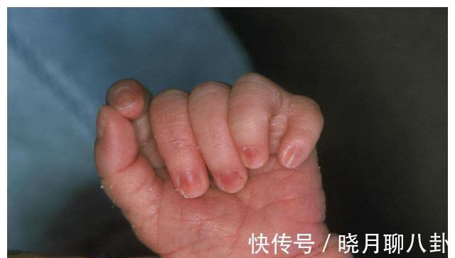 先天性心脏病|有多少孩子产检没问题,却出生后发现有问题?四种情况孕检查不出