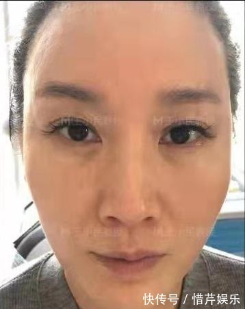 小拉皮 拉皮除皱王小民教授:46岁的她选择了小拉皮手术,看看效果反馈!