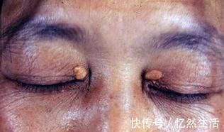 降血脂|血脂高都是肥肉造成的?医生:不是!这3物才是血脂的“加速器”