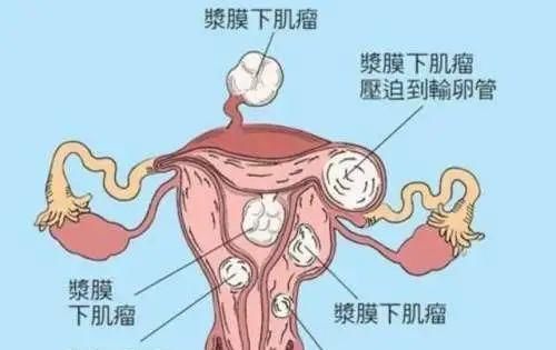 子宫肌瘤3大形成原因：炎、寒、气！中医1招，化瘀散结，彻底降服