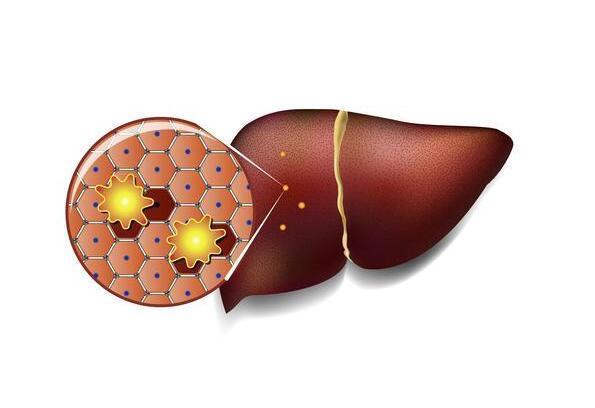 肝脏|身体出现4个“变化”,可能是脂肪肝的“敲门声”,别掉以轻心