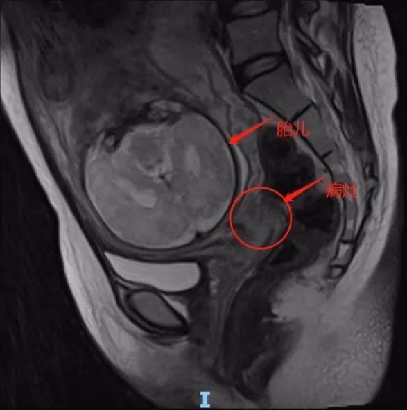 妈妈|怀孕25周查出宫颈癌,年轻妈妈做出这样一个决定