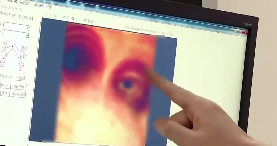 帅哥|帅哥6岁吞哨子因怕被骂瞒了20年，如今咳得不行了才做手术取出