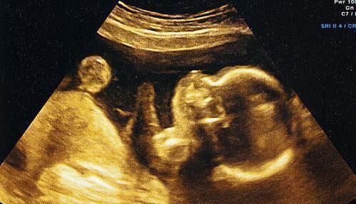 b超|每次产检结果正常,孩子生出后发现畸形,医院需要负责吗?