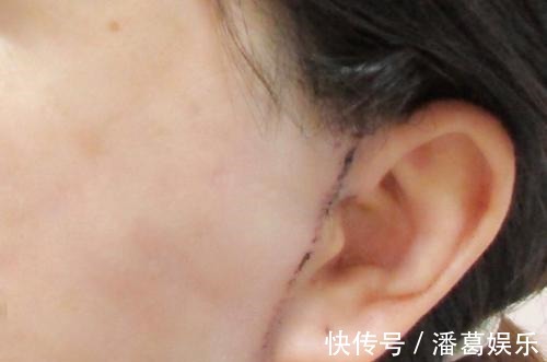 小拉皮 面部拉皮王小民教授:你要悄悄逆生长,然后惊艳所有人!