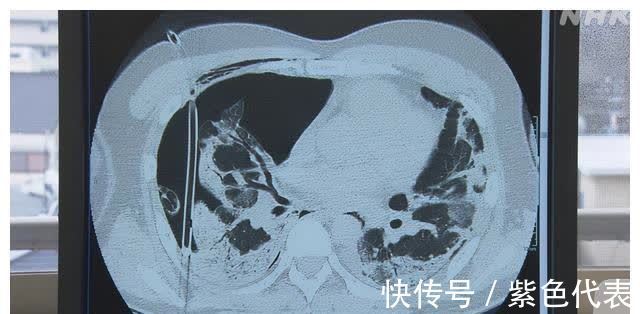 肺部|日本新冠患者2个月的治疗过程 挣扎在生死边缘