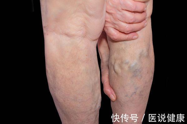静脉|下肢出现这4种异常,当心静脉曲张已找上门,及时检查,别忽视