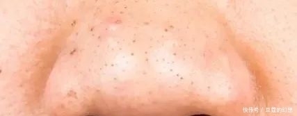 黑头|鼻头上 “黑头粉刺” 的清除方法及误区……及时纠正!