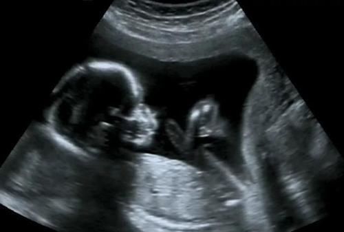 彩超|做四维医生说腹部脂肪厚,看不清,打出来单子也只能看宝宝大概面部怎么办?