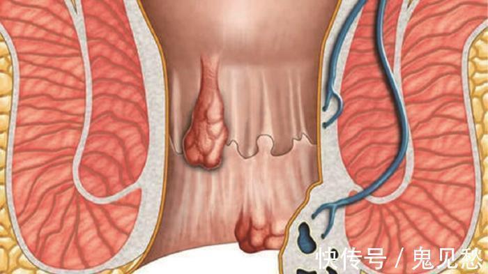 野菜|痔疮天然“克星”竟在身边!这种野菜天天吃,止血阵痛消肉球!