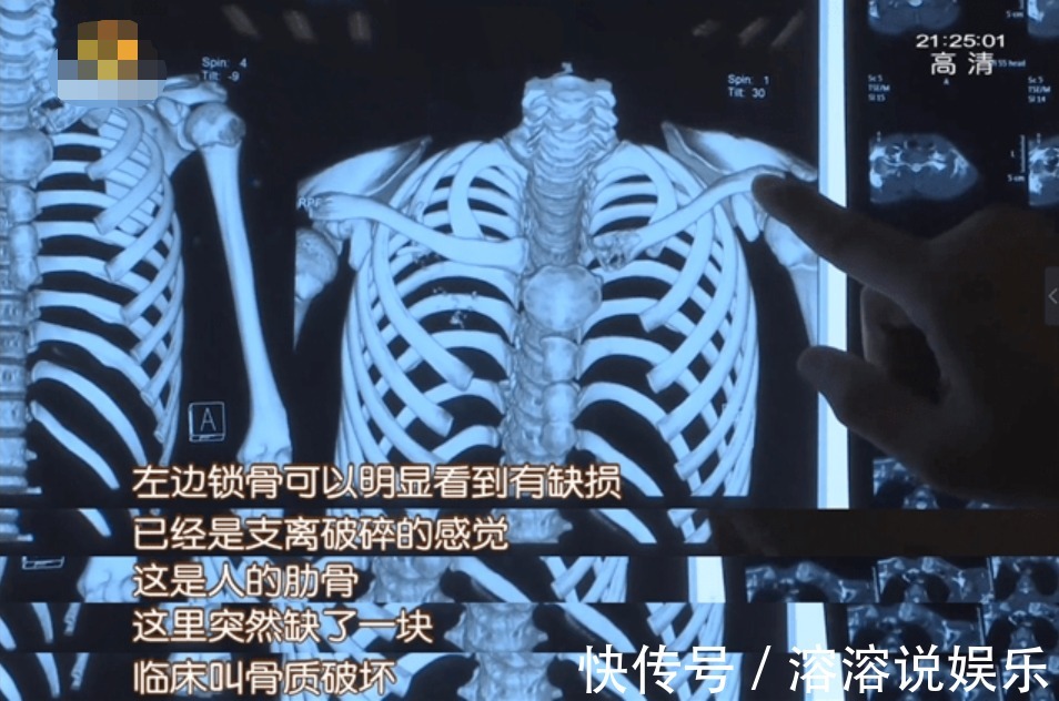 小家|年仅12岁，肺癌晚期！妈妈说出的这几个生活习惯，很多孩子都有