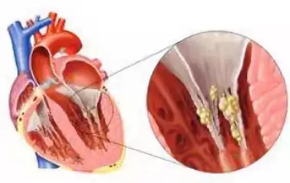 张磊磊|70岁老人反复发热竟是感染性心内膜炎，心外科实施二尖瓣生物瓣膜置换解难题