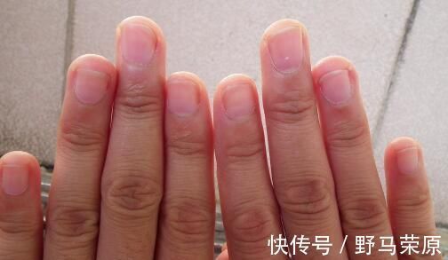 绿脓杆菌|指甲出现这些变化, 它在暗示你的身体里有病!