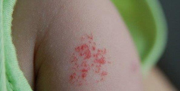 无色素痣|宝宝身上这3种“印记”,可能藏着疾病,发现了要及时去医院!