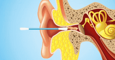医生|为什么「掏耳朵」那么爽，医生却叫你住手？