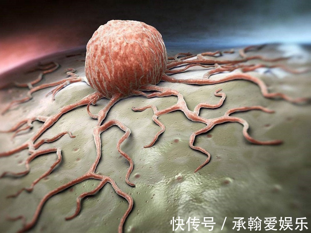 脂肪瘤|这3种瘤都是良性病变,医生提醒一旦查出来,不必自己吓自己