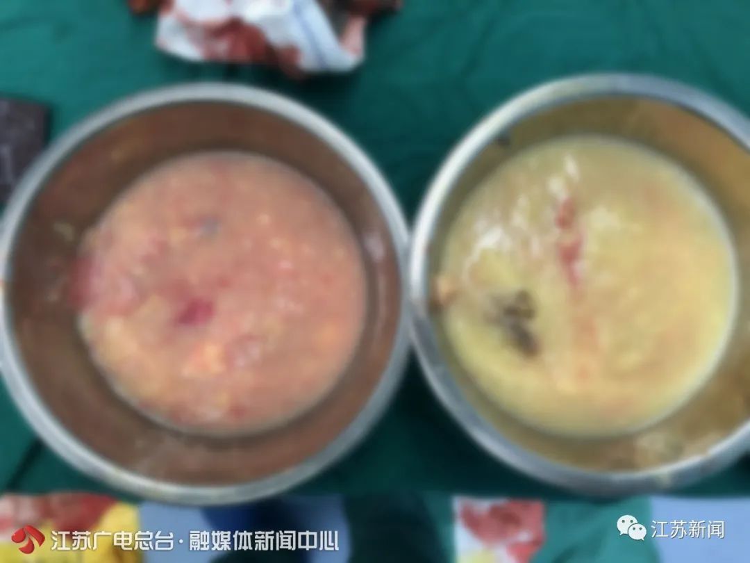 女子胸部取出1000毫升变质物只因25年前一个冲动的决定…