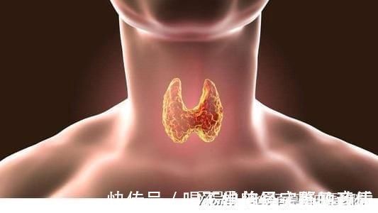 癌变|甲状腺癌变的“三个特征”出现了就需要及时警惕!
