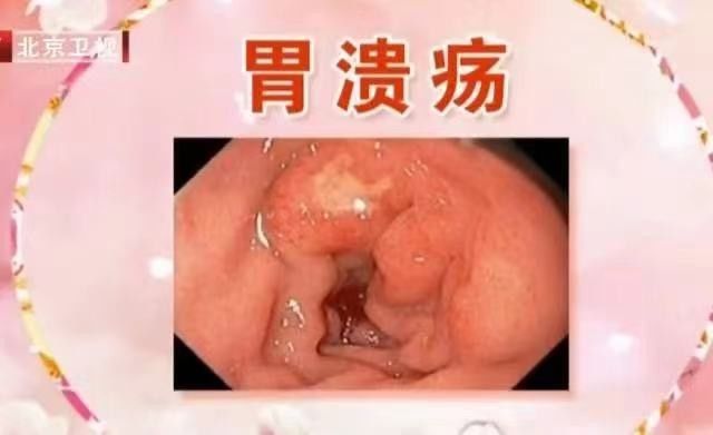 胃病|胃病无小事，一不小心可能拖成癌！有这些迹象要及时就诊