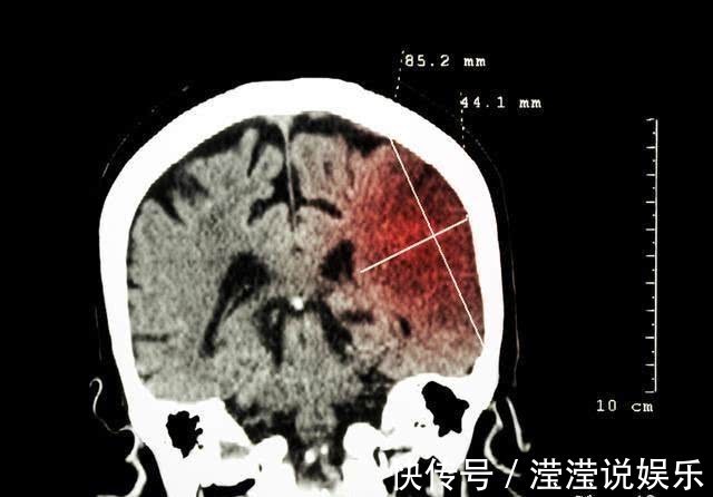 医生|男子突发脑梗,入院就下了病危,医生直言这''习惯''害了不少人