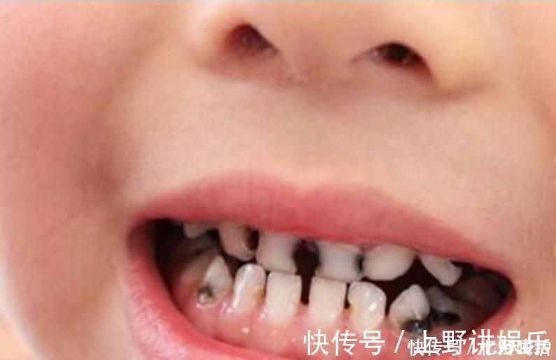 暮沐|3岁宝宝满口“小黑牙”,罪魁祸首并非糖果,而是家长的无知