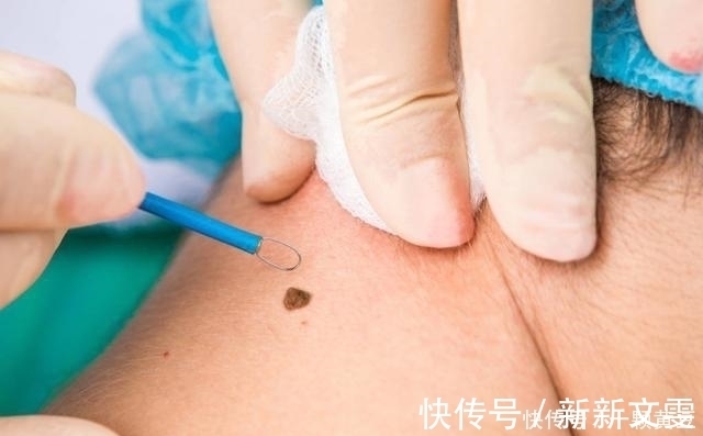 斑痣|身上长这2种痣时,需引起重视,以免危害健康