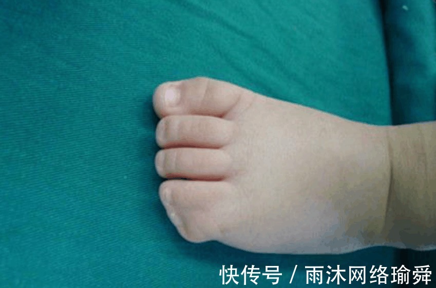 医生|孩子出生就有25根指头, 医生看到宝妈的手, 明白了原因