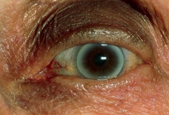 结子|血脂高不高,查看身上3个部位就知道,稳定血脂谨记2少2多