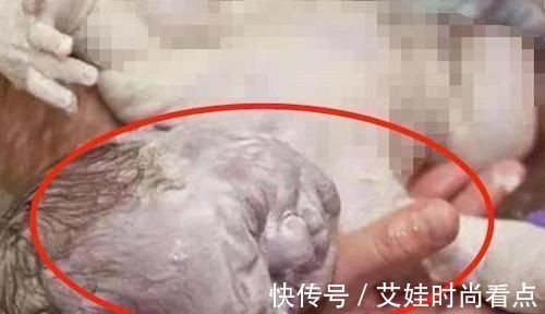 颜值|十月怀胎,孕妇产下“雪人”宝宝,宝爸都被宝宝外貌吓到了