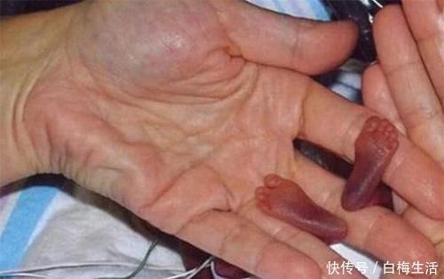 世界上“最小的婴儿”,出生时1斤不到,现已长成挺拔少年
