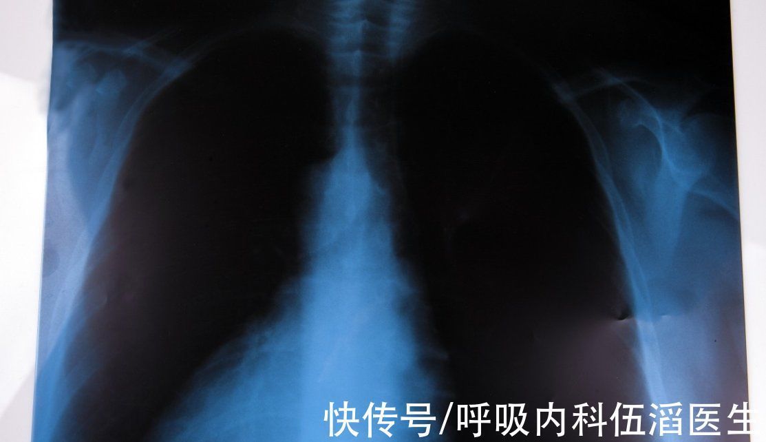 毛玻璃|查出肺结节，就意味着癌变的前兆吗？一名肺结节患者的亲身经历