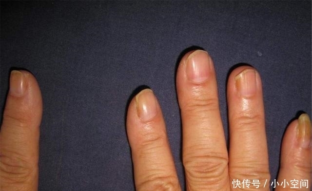  肝脏|肝不好的人，手上可能有这3个表现，记住3个动作，肝慢慢变好