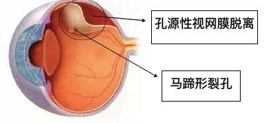 近视|【协和医生说】全国儿童青少年近视率已达53.6%！