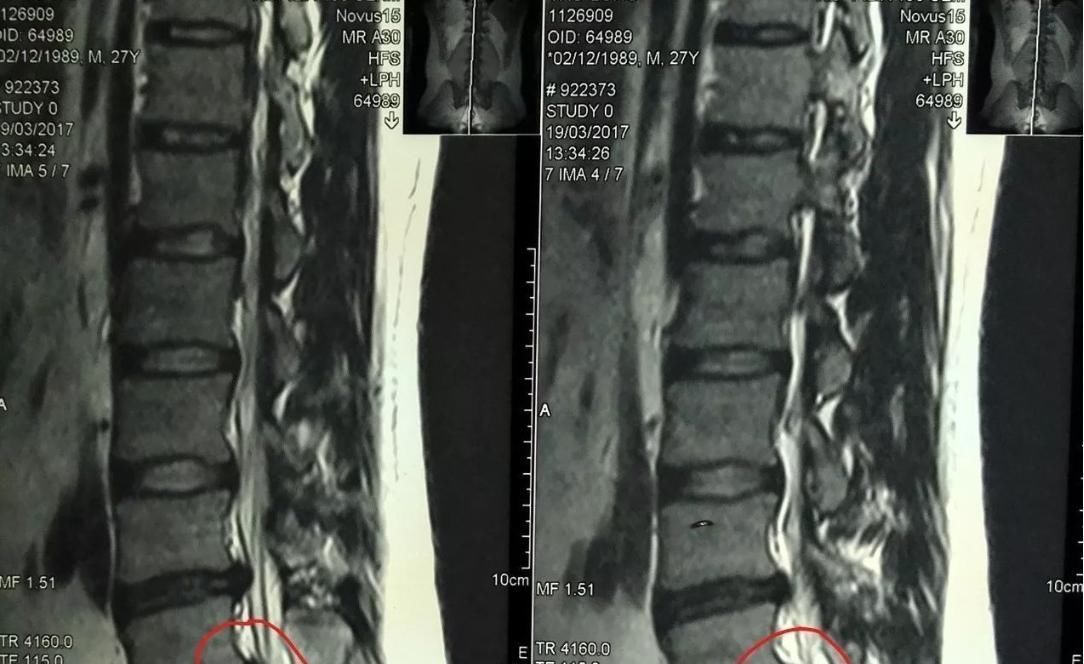 手术治疗|腰椎间盘突出真实经历过程,腰椎间盘突出症原来可以这么做