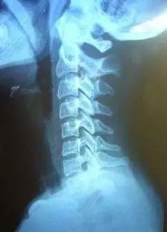 白萝卜|颈椎病的你,可别再愁了,只需3招,就能远离疼痛、手麻!