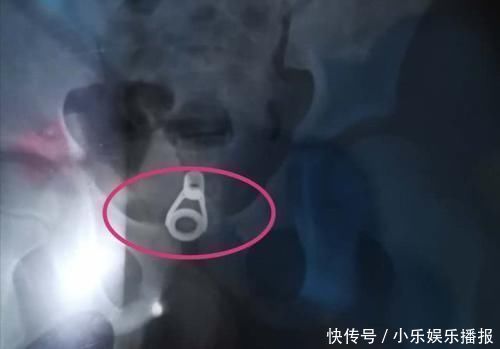 y道|为救六岁女童医生小心翼翼,家长一定不要额外损伤