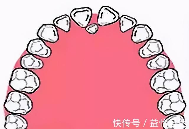 牙齿|孩子12岁前必须处理的牙齿问题!家长都了解吗?