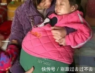 畸胎瘤|7岁小女孩肚子越来越大,去医院检查竟真的怀有胎儿