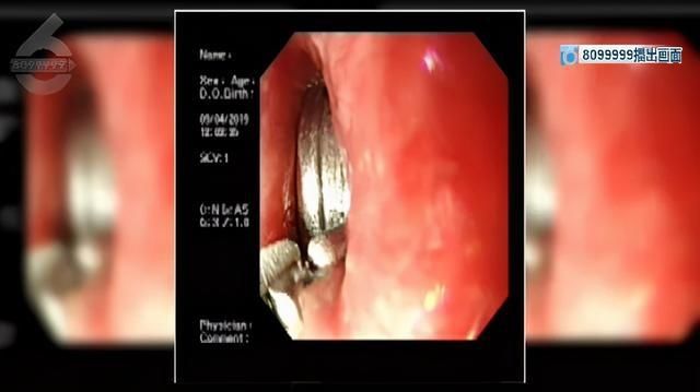 实验|全国各地都有孩子误食这个东西！记者用鸡肉做实验，结果触目惊心