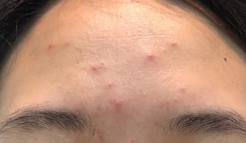 痘痘|对于脸上不断冒痘的原因有哪些？要如何改善呢？