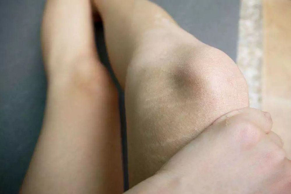 概率|怀孕就长妊娠纹?不一定,当孕妈符合以下条件,那就不容易长