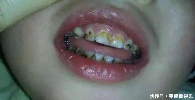 牙齿|家里这3样东西,比糖还容易让孩子长“黑牙”,家长别让孩子碰
