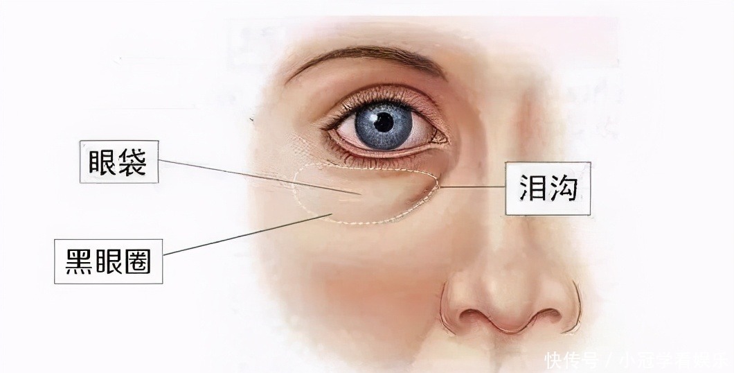 卧蚕主要分为3类：渐宽型更显幼态，月牙形最少见，你是哪一种？