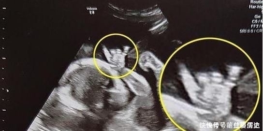 b超|孕妇做B超被吓坏,孩子突然睁眼怪笑!医生却说……