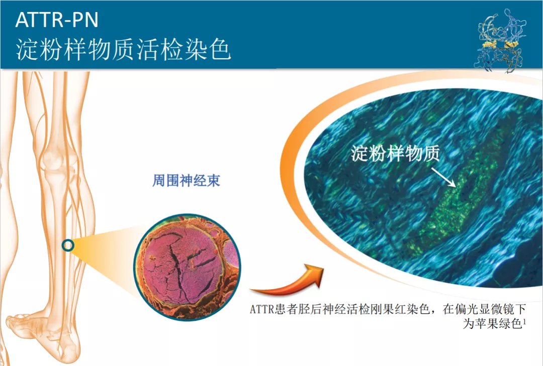 淀粉人|70岁大妈被诊断为“淀粉人”，家族中数人罹患，全球患者不超过5万例