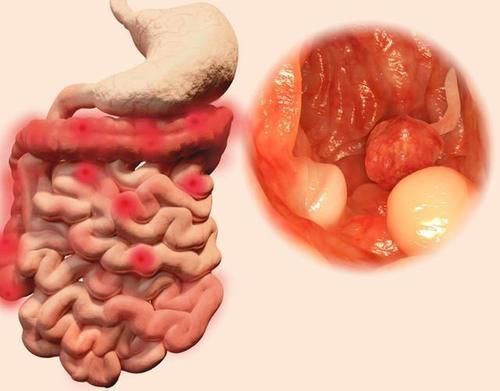 胆囊息肉|息肉一定会癌变吗提醒四种息肉拖不得,越早切除越好
