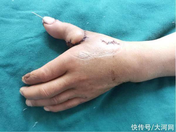 李师傅|7小时奋战,医生让患者脚趾“移花接木”变拇指